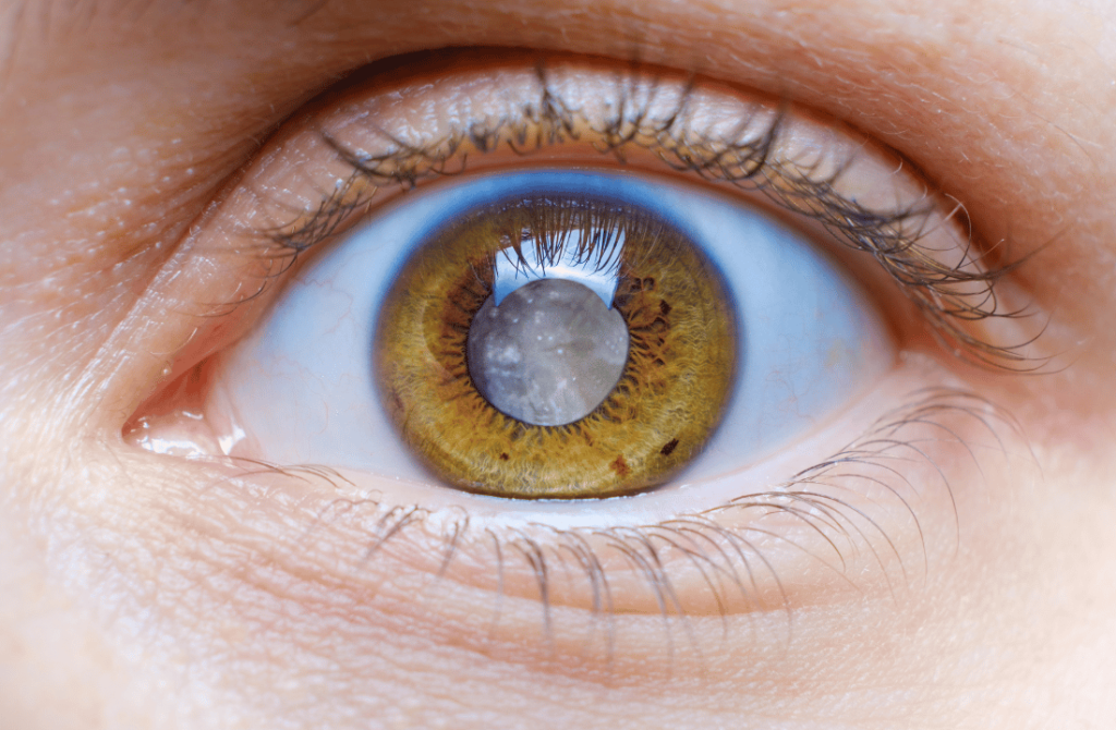 Close-up of a cloudy cataract-affected eye, showing blurred lens caused by cataract condition.