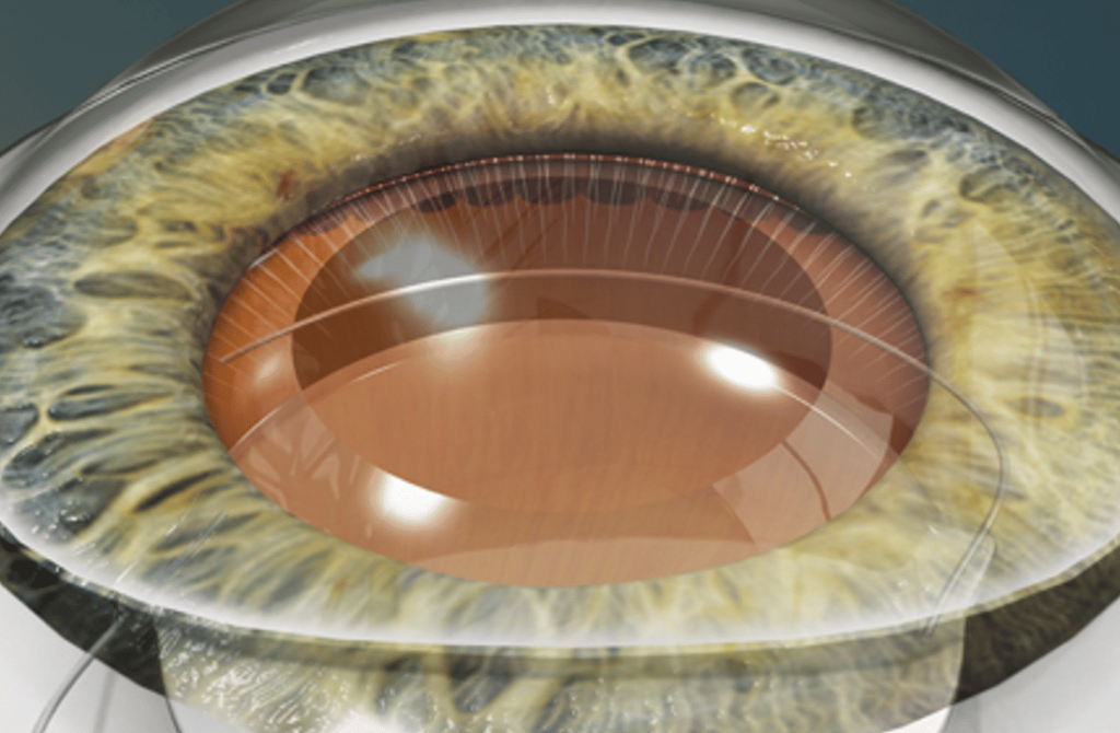 Illustration of Extracapsular Cataract Extraction (ECCE), a traditional cataract removal technique.