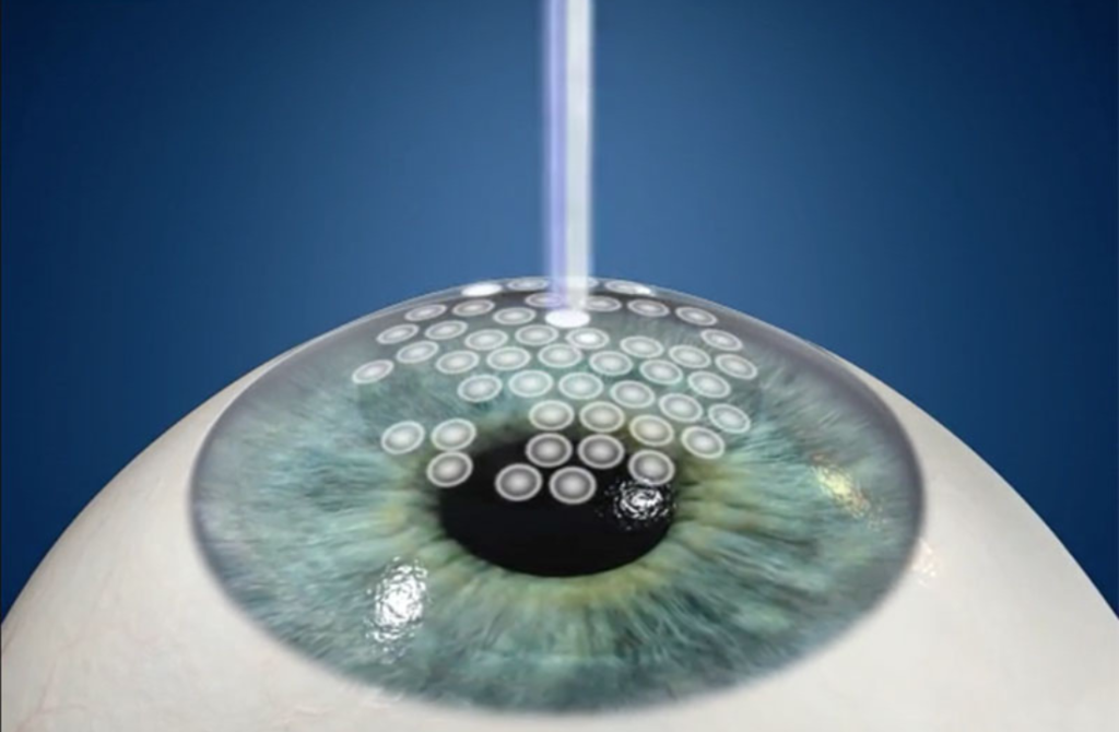 An eye undergoing PRK, a laser treatment to reshape the cornea and correct refractive errors.