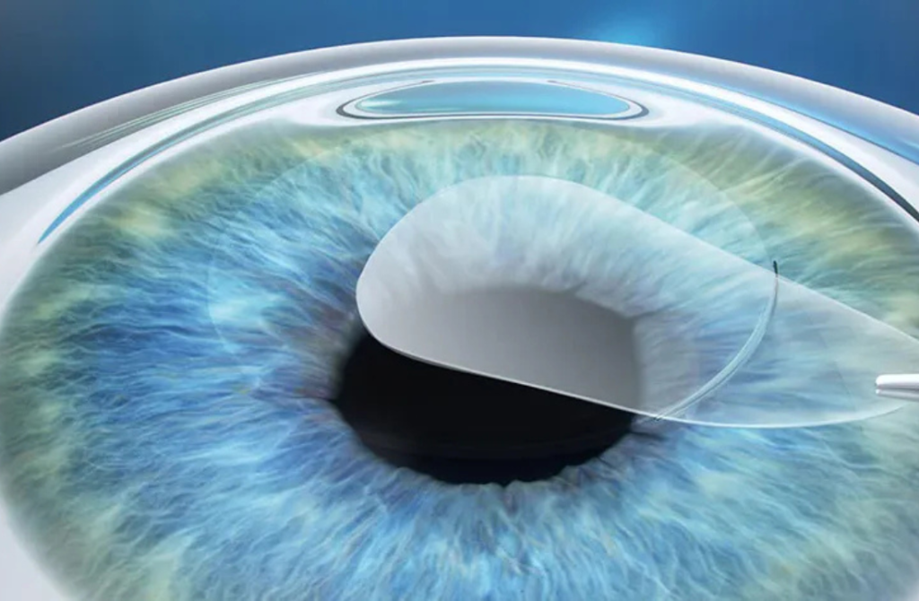 An eye undergoing SMILE, a minimally invasive surgery for vision correction using a small incision.