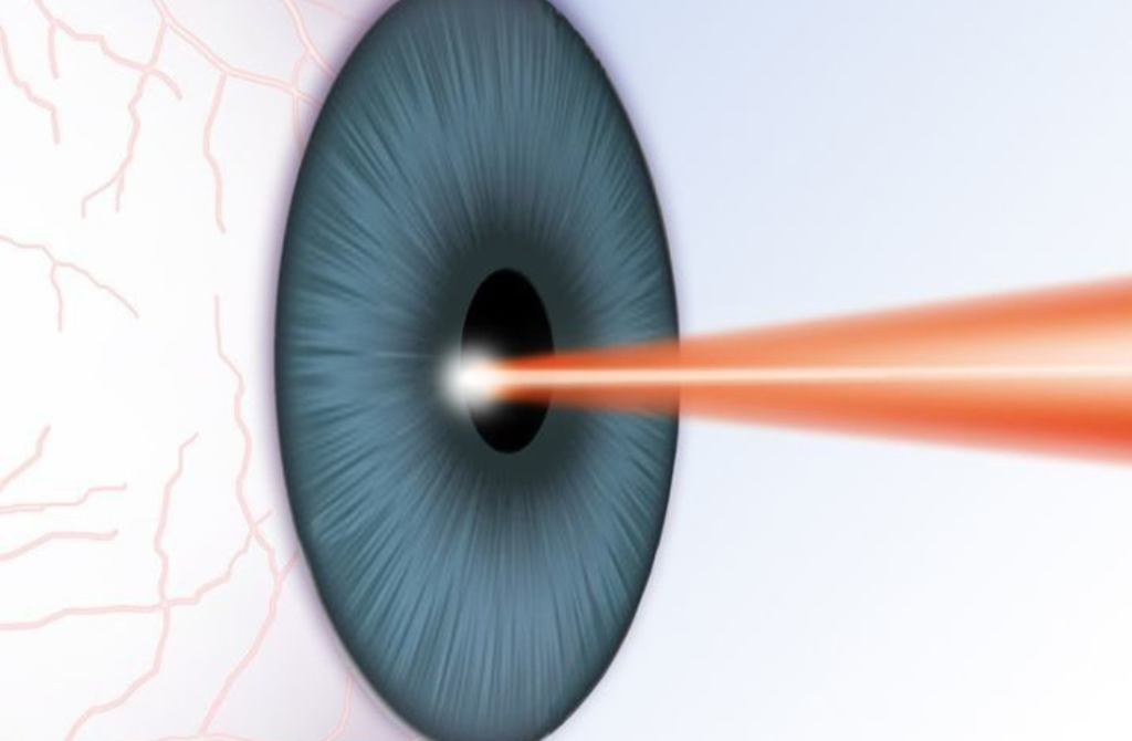 An eye undergoing traditional LASIK surgery with a laser to reshape the cornea for vision correction.