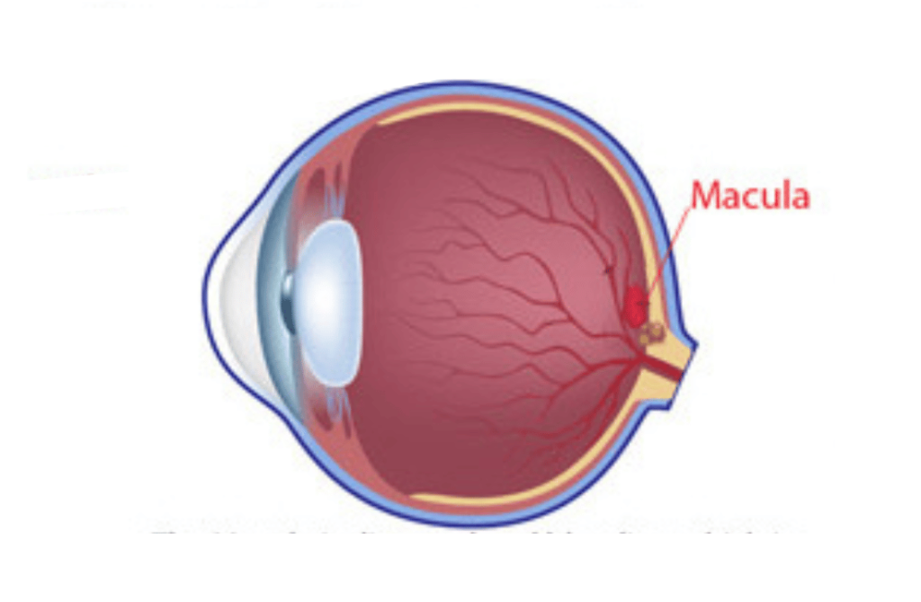 Depiction of an eye affected by age-related macular degeneration, showing changes in the central retinal area responsible for sharp vision.