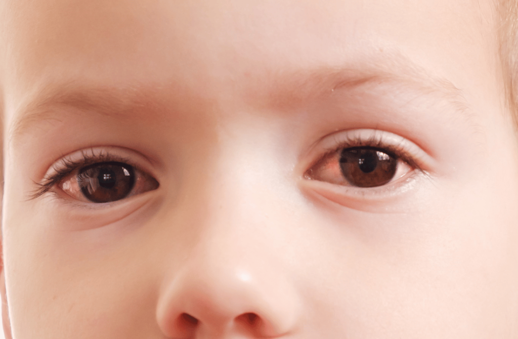 Boy with red and swollen eyes, a common sign of conjunctivitis (pink eye).