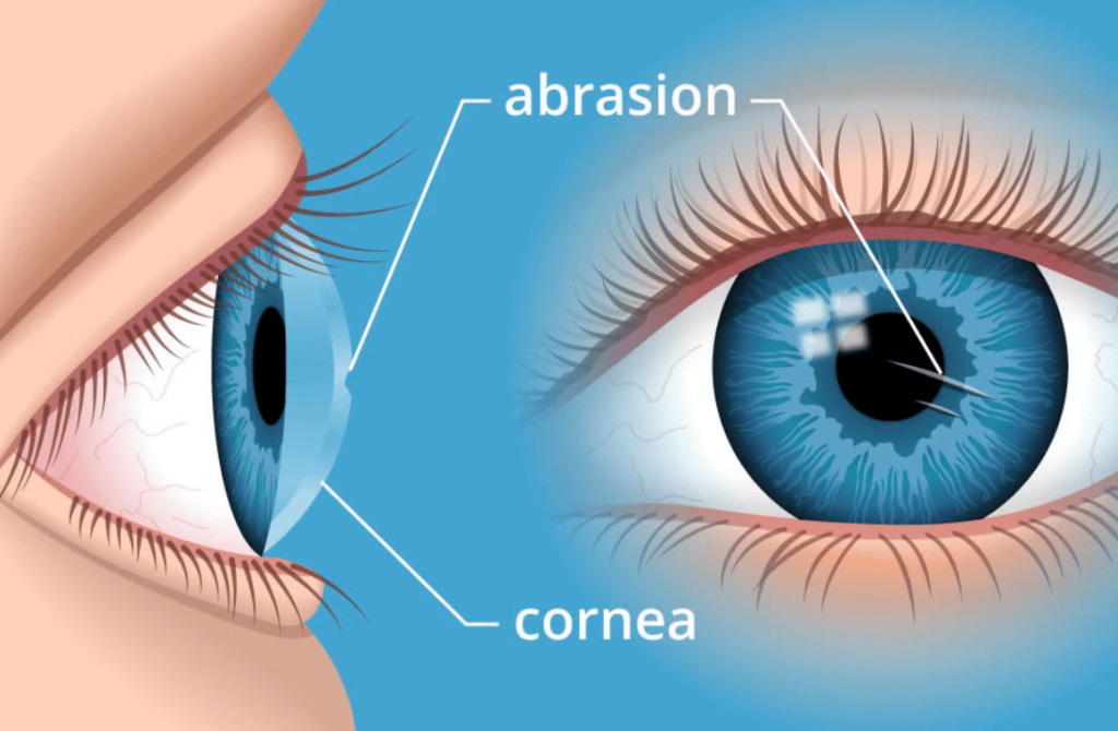 Image of a cornea with visible scarring, often resulting from injury, infection, or surgery, affecting vision clarity.