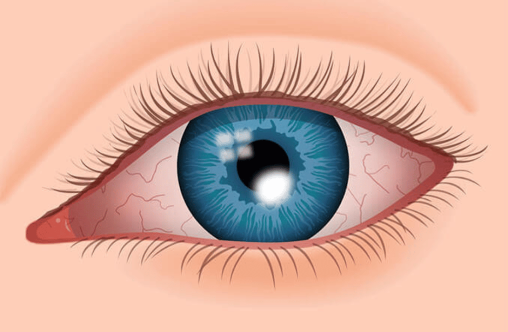 Image showing a corneal ulcer on the eye, typically caused by infection or injury, affecting vision and eye health.