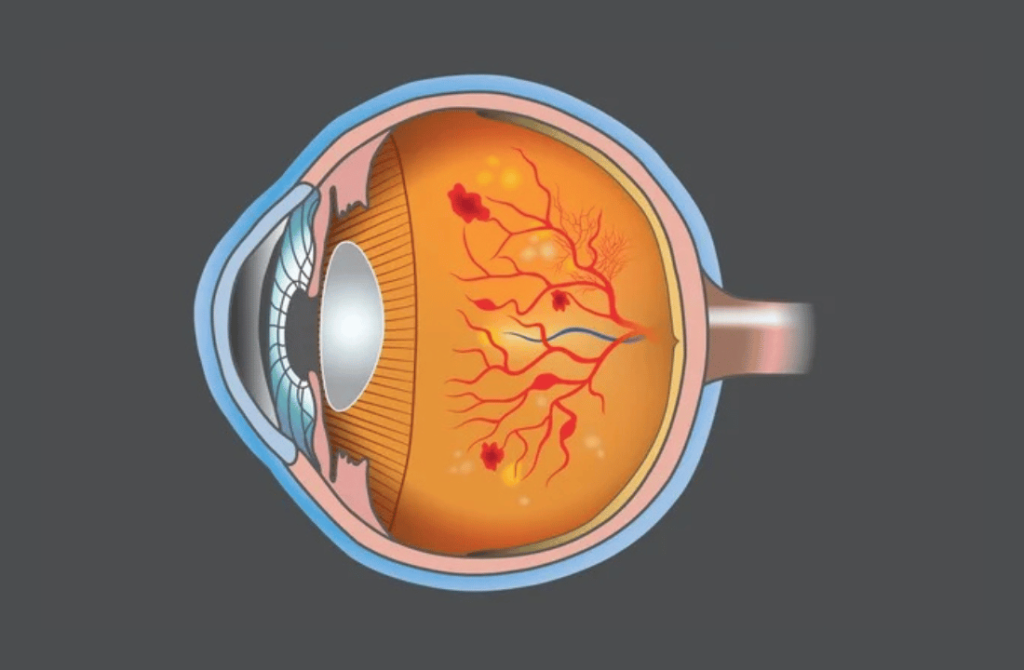 Illustration of an eye affected by diabetic retinopathy, showing retinal damage due to prolonged high blood sugar levels.