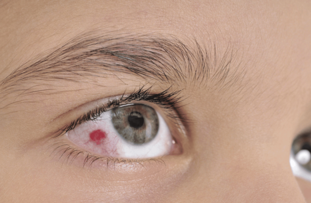 Image of a young boy with visible signs of an eye injury, emphasizing the need for immediate care.