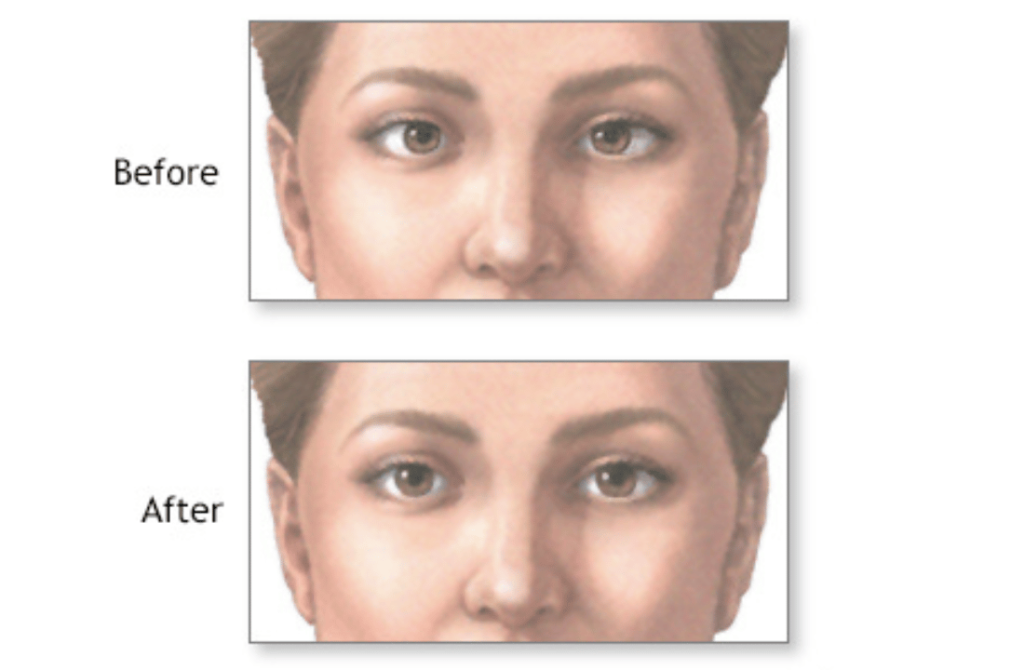 Comparison image showing the results of eye muscle surgery before and after squint correction at the Best Squint Clinic in Nagpur.