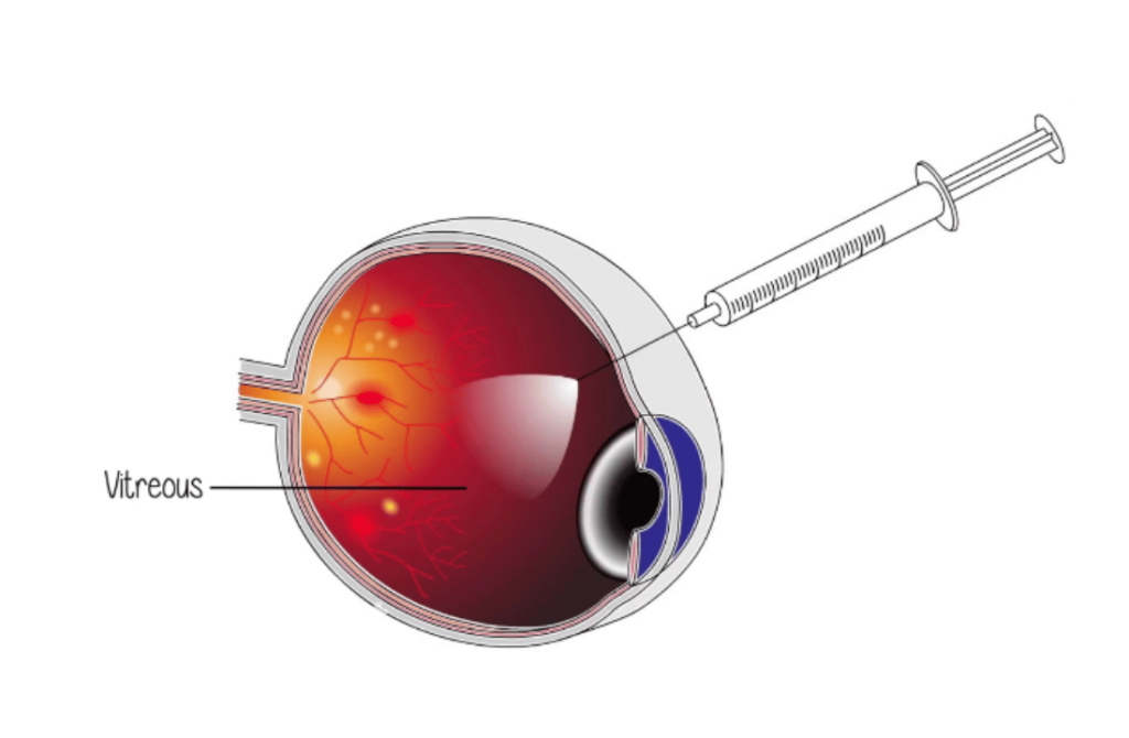 Close-up of an eye receiving an intravitreal injection, a specialized treatment available at the Best Retina Clinic in Nagpur for managing retinal diseases effectively.