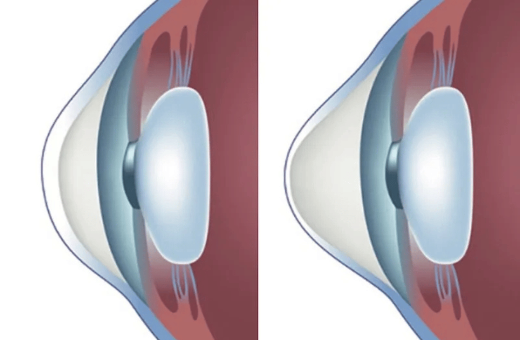 Close-up of a cornea showing signs of keratoconus, a condition that causes thinning and bulging of the cornea.