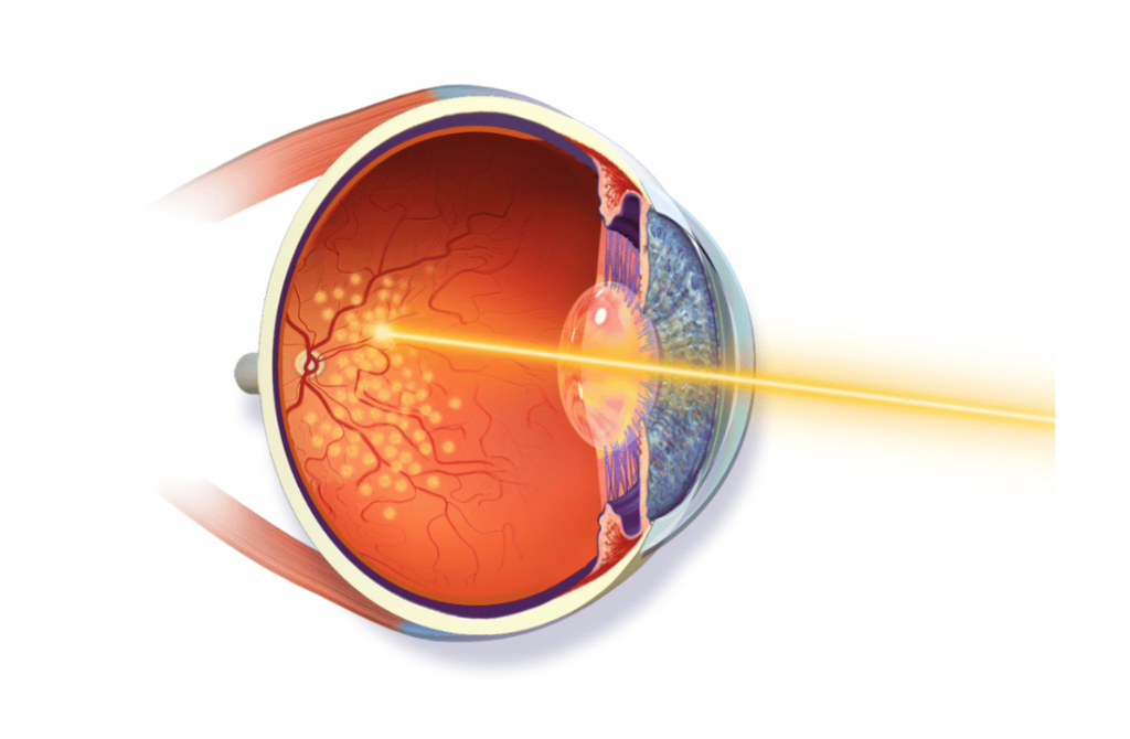 Image of an eye undergoing laser treatment to manage retinal conditions and prevent further vision loss.