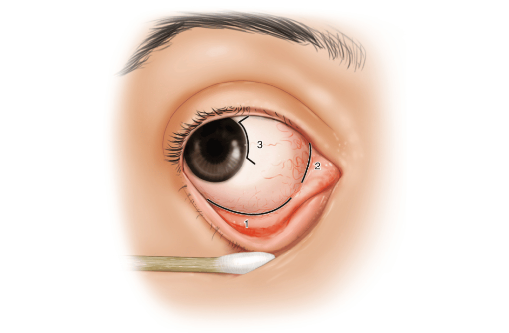 Image of an eye depicting orbital surgery areas for conditions like tumors or fractures around the eye.