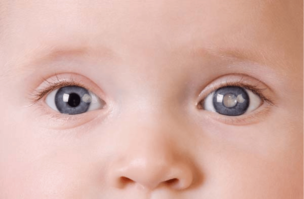 Image of a child’s eye affected by pediatric cataracts, causing a cloudy or opaque appearance.