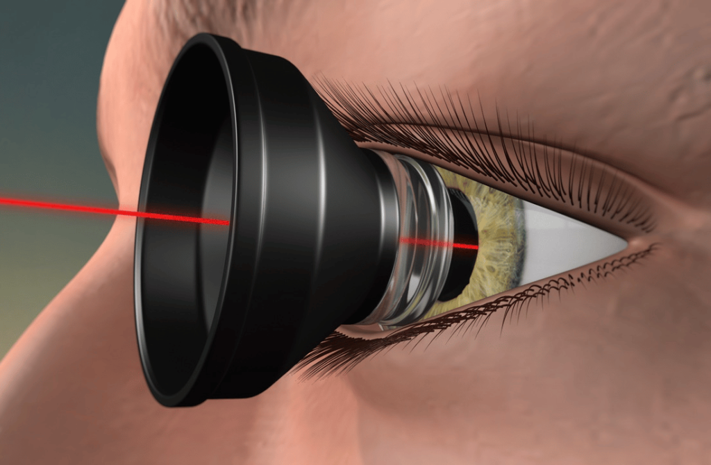 Depiction of an eye undergoing photodynamic therapy, a specialized laser treatment for certain retinal diseases.