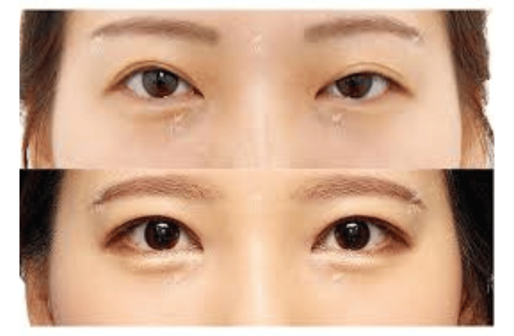 Before-and-after images showing the correction of drooping eyelids (ptosis) for restored vision and aesthetics.