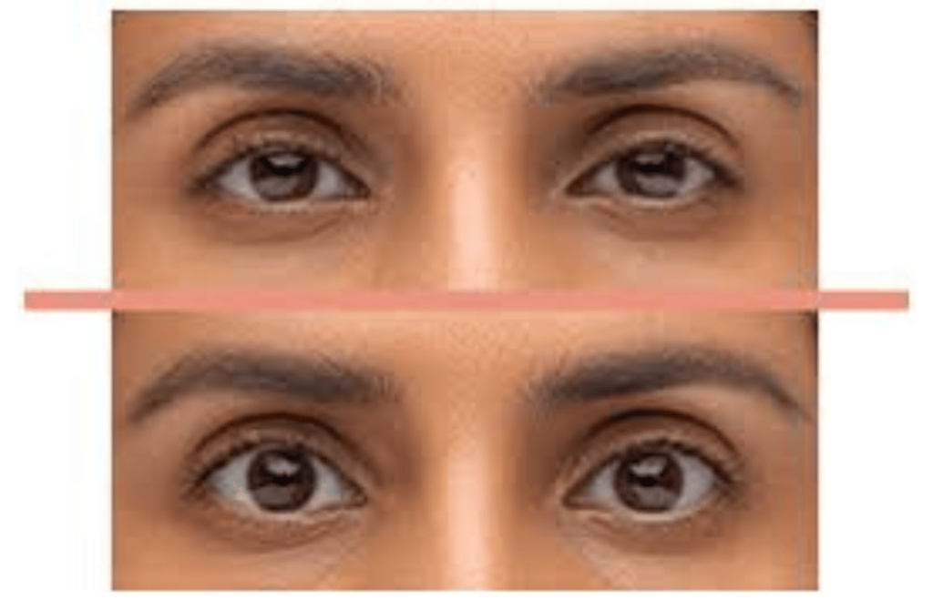 Before-and-after images of reconstructive surgery, demonstrating restored eye and facial symmetry.