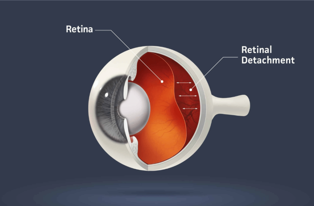 Image of an eye illustrating retinal detachment, a condition where the retina separates from the back of the eye.