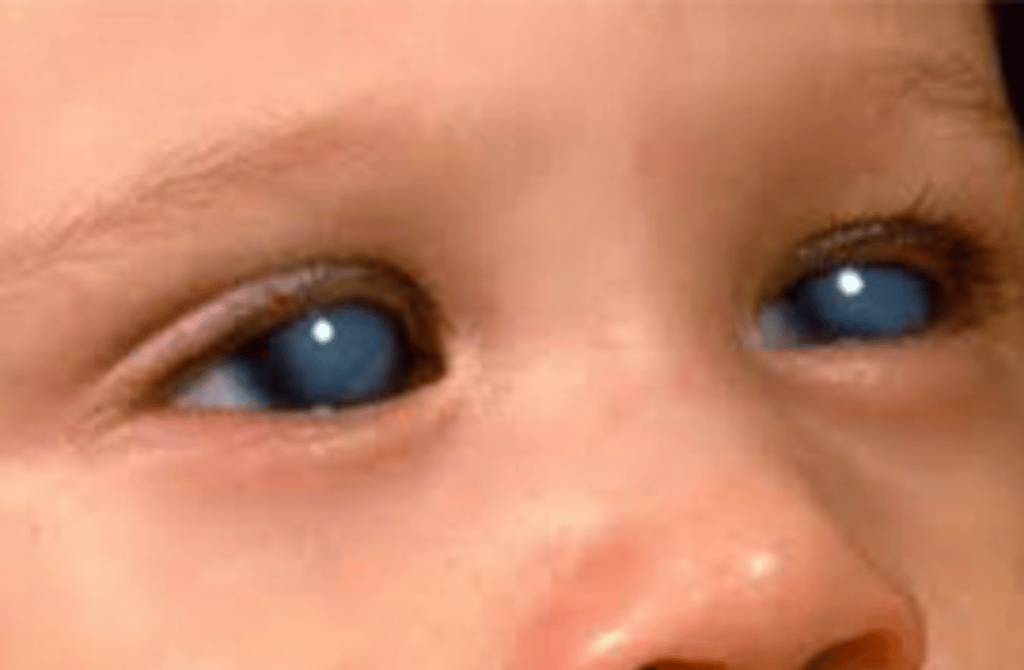 Close-up of an eye affected by retinopathy of prematurity (ROP), often seen in premature infants.