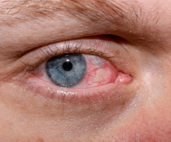 Close-up image of a red eye due to corneal irritation or infection.