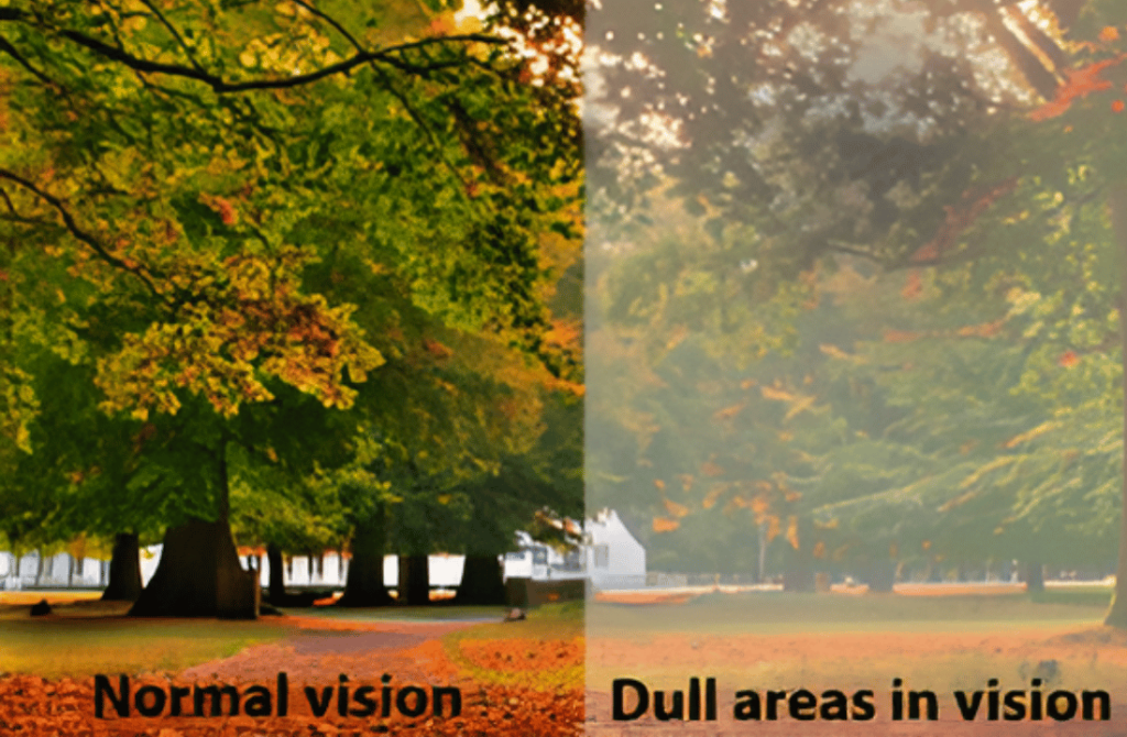 Comparison image of a tree, illustrating normal vision versus dull or blurred areas caused by retinal disorders.