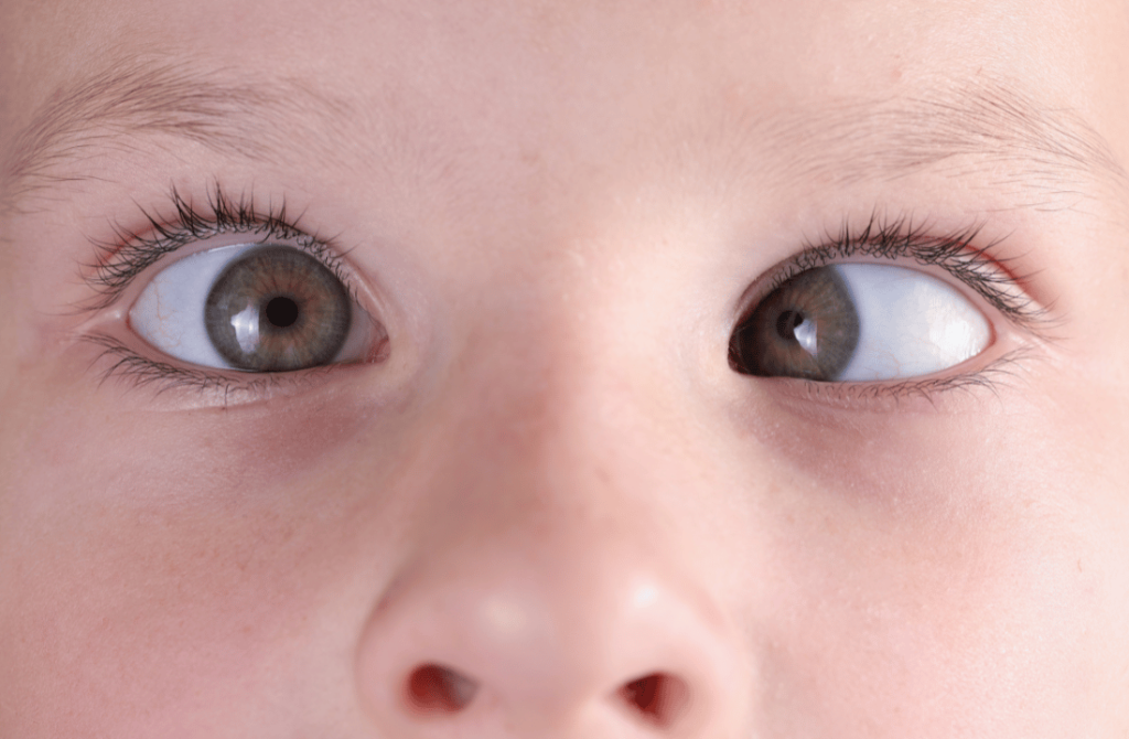 Close-up of a young boy with visible squint eyes, highlighting the need for specialized eye treatment.