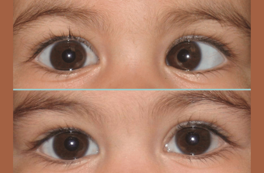 Comparison of eyes before and after strabismus surgery, showing corrected alignment.