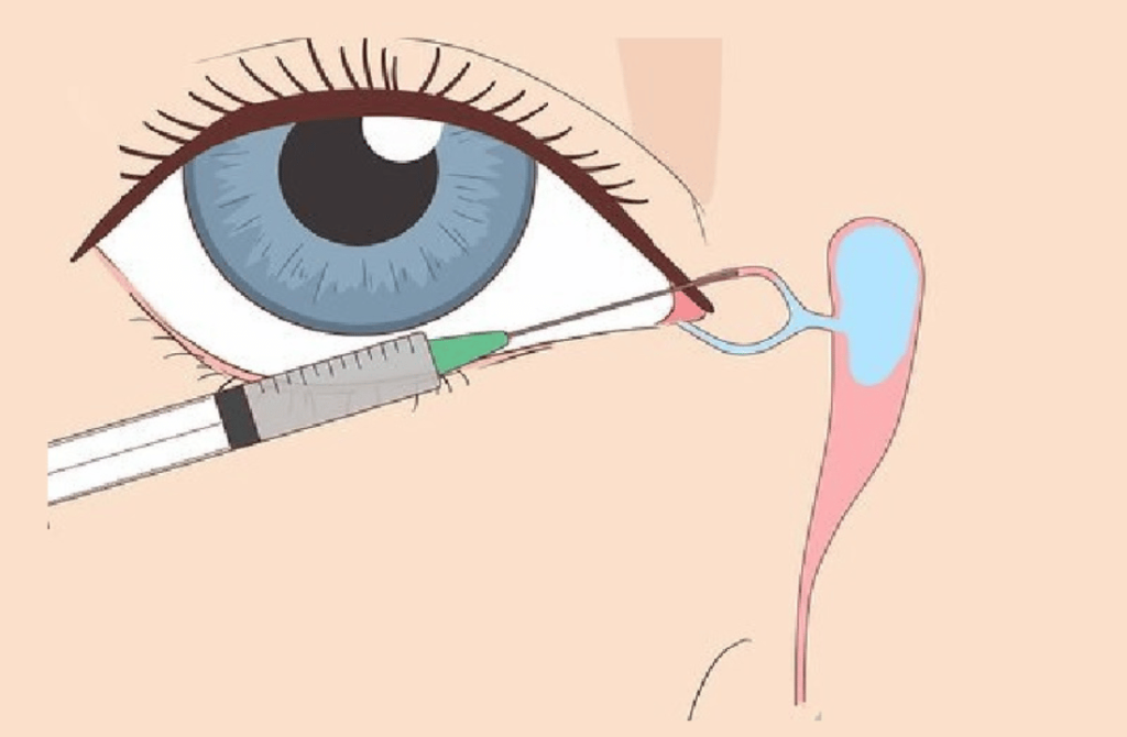 Eye image illustrating the area affected by tear duct surgery to restore proper tear drainage.