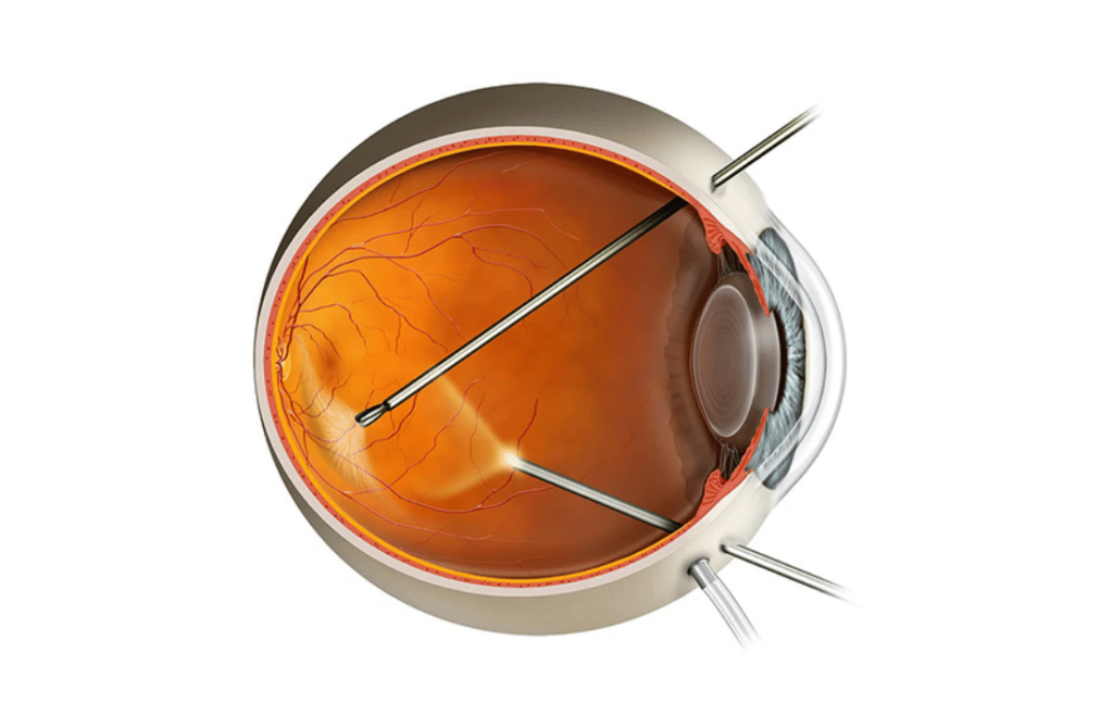 Illustration of an eye during vitrectomy surgery, a procedure to remove the vitreous gel and treat retinal detachment or other conditions.