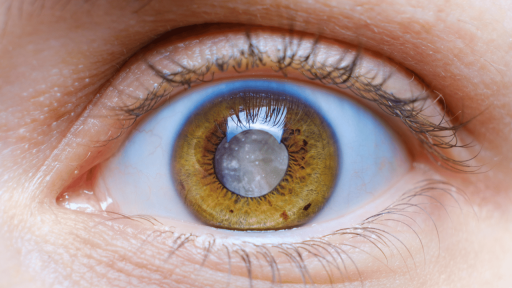 Understanding Cataract Surgery