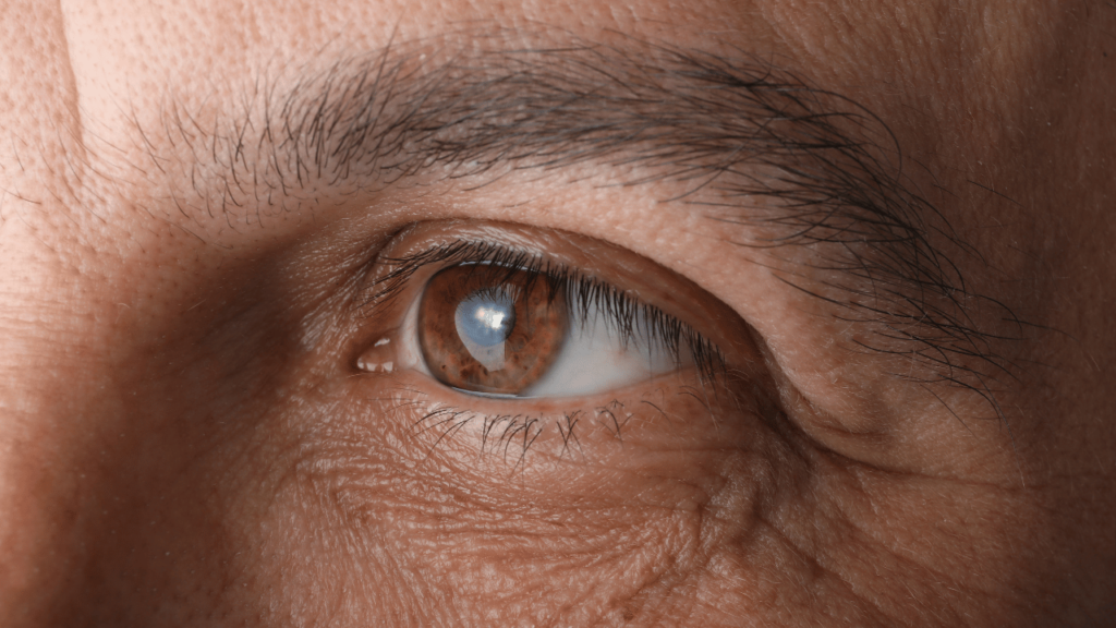 Understanding Cataract Surgery