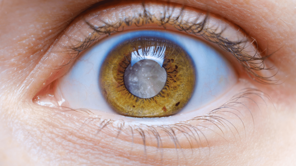 Understanding Cataract Surgery