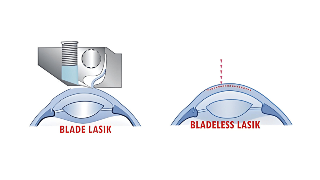 What is Bladeless LASIK Surgery