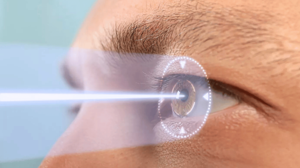 What is LASIK