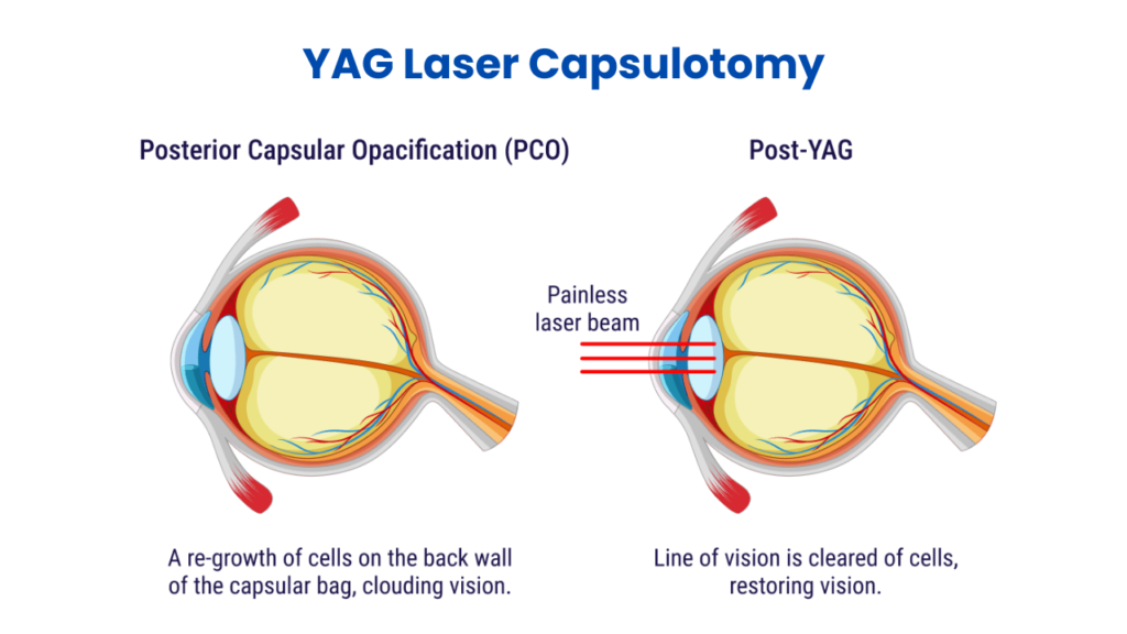 YAG Laser Capsulotomy for PCO