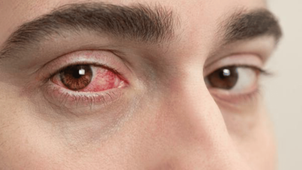 Understanding Eye Flu (Viral Conjunctivitis)