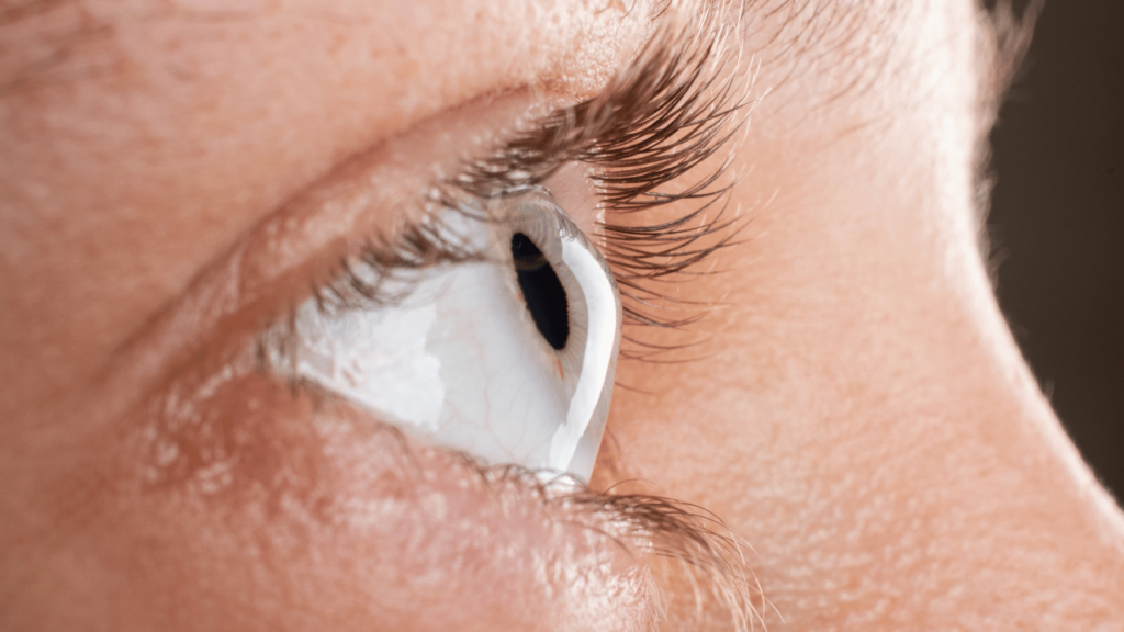 Understanding Keratoconus & Its Treatment